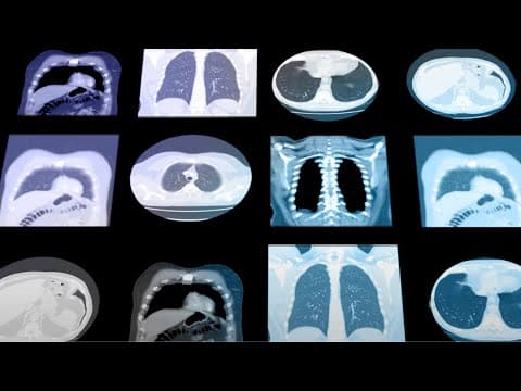 Sybil: An AI model that can predict lung cancer risk 6 years in advance